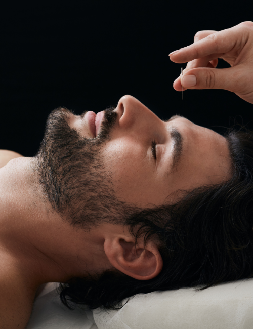 Acupuntura
